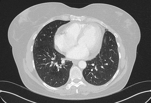 Cardiac sarcoidosis (Radiopaedia 74548-85534 Axial lung window 58).jpg
