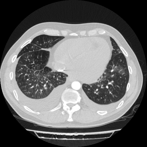 Cardiac tamponade (Radiopaedia 78607-91368 Axial lung window 68).jpg