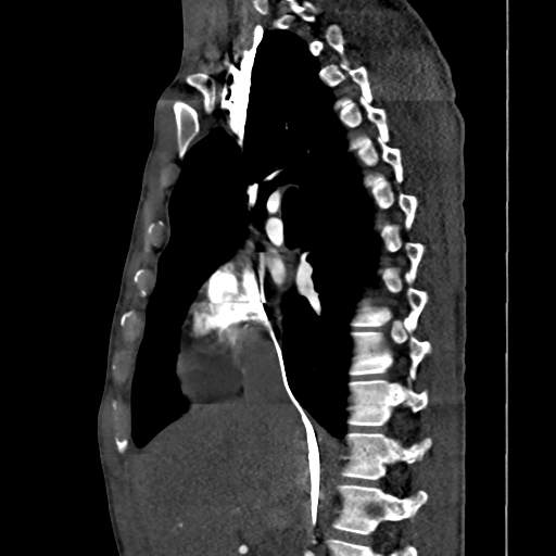 File:Cardiac tumor - undifferentiated pleomorphic sarcoma (Radiopaedia 45844-50134 B 48).png