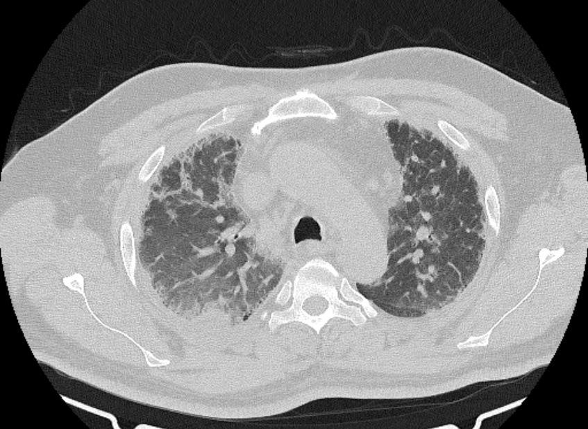 Cardiogenic pulmonary edema (Radiopaedia 68180-77678 Axial lung window 24).jpg
