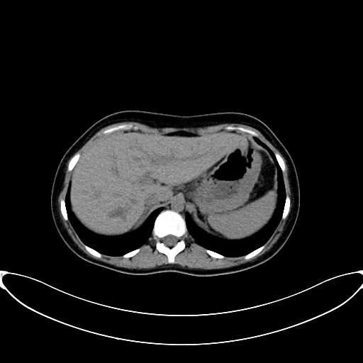Caroli disease with medullary sponge kidney (Radiopaedia 82622-96804 Axial non-contrast 18).jpg