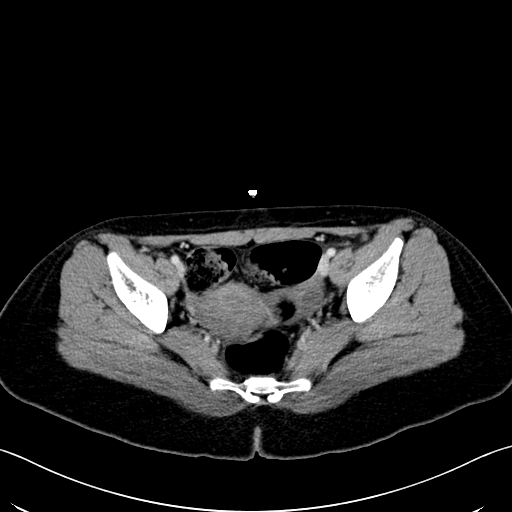 Caroli disease with medullary sponge kidney (Radiopaedia 82622-96804 C 66).jpg