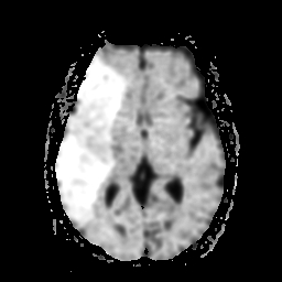 File:Carotid arterial dissection with acute cerebral infarction (Radiopaedia 26636-26784 Axial Exp ADC 11).jpg