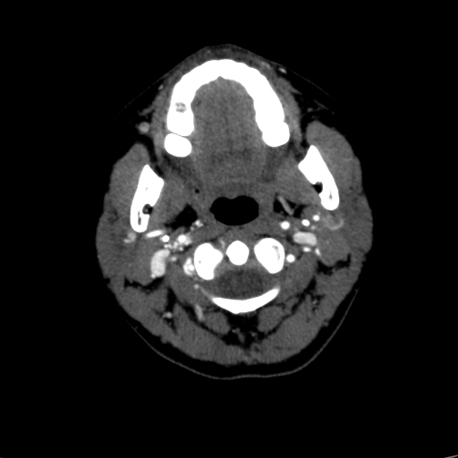 File:Carotid body tumor (Radiopaedia 39845-42300 B 60).jpg