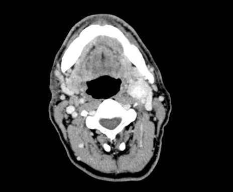 Carotid body tumor (Radiopaedia 61750-69757 Axial Post contrast 41).jpg
