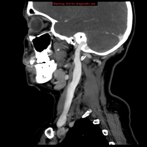File:Carotid body tumor with lung metastases (Radiopaedia 9301-9986 Sagittal C+ delayed 14).jpg