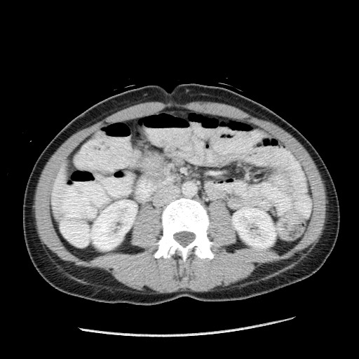 File:Castleman disease with fibrous pseudotumor in the abdomen (Radiopaedia 77296-89373 A 64).jpg