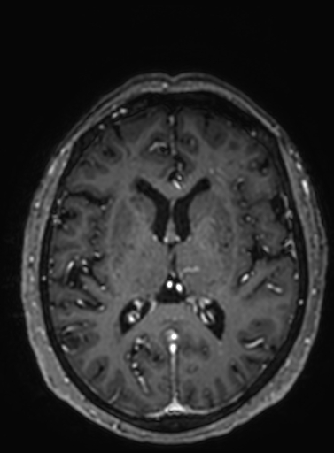 File:Cavernous hemangioma of the cerebellar falx (Radiopaedia 73025-83724 Axial T1 C+ 155).jpg