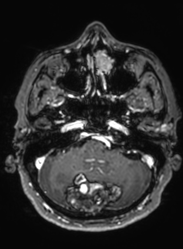 File:Cavernous hemangioma of the cerebellar falx (Radiopaedia 73025-83724 Axial T1 C+ 264).jpg