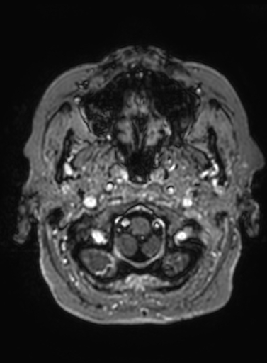 File:Cavernous hemangioma of the cerebellar falx (Radiopaedia 73025-83724 Axial T1 C+ 314).jpg