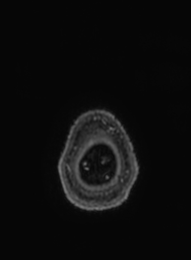 Cavernous hemangioma of the cerebellar falx (Radiopaedia 73025-83724 Axial T1 C+ 7).jpg