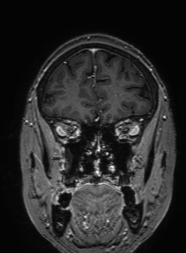 Cavernous hemangioma of the cerebellar falx (Radiopaedia 73025-83724 Coronal T1 C+ 90).jpg