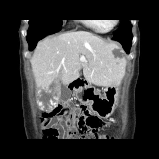 Cavernous hepatic hemangioma (Radiopaedia 75441-86667 C 36).jpg