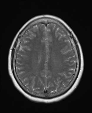 File:Cavernous sinus meningioma (Radiopaedia 63682-72367 Axial T2 16).jpg
