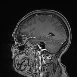 Cavernous sinus meningioma (Radiopaedia 63682-72367 Sagittal T1 C+ 117).jpg