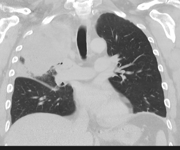 Cavitating pneumonia (Radiopaedia 45998-50329 Coronal lung window 26).png