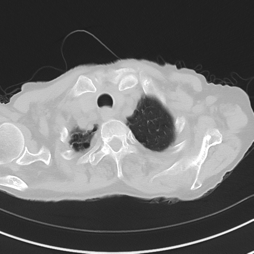 Cavitating pneumonia - lingular segments (Radiopaedia 34386-35678 Axial lung window 9).png