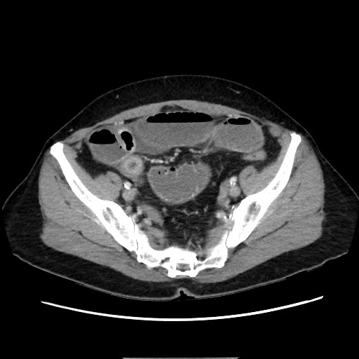 Cecal adenocarcinoma (Radiopaedia 75909-87331 A 71).jpg