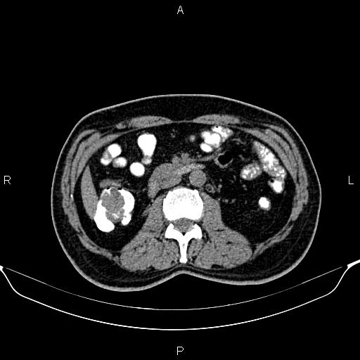 Cecal adenocarcinoma (Radiopaedia 85324-100916 Axial non-contrast 44).jpg