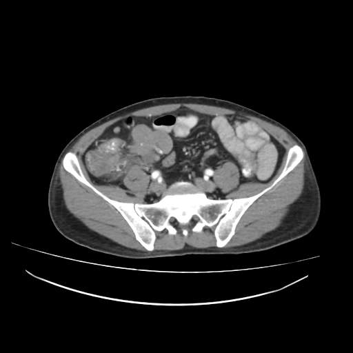 Cecal carcinoma with local lymphadenopathy (Radiopaedia 31428-32240 A 37).jpg