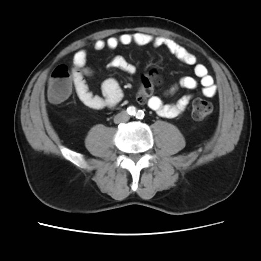 File:Cecal mass causing appendicitis (Radiopaedia 59207-66531 A 52).jpg