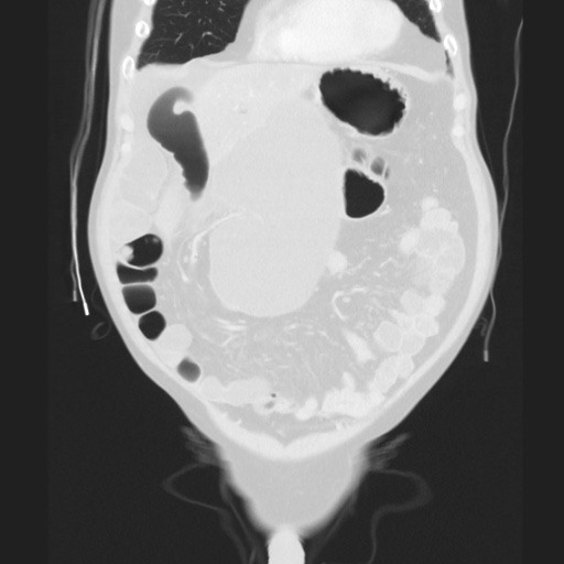 Cecal volvulus (Radiopaedia 75378-86620 Coronal lung window 48).jpg