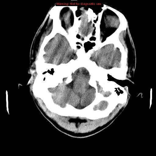 File:Central nervous system vasculitis (Radiopaedia 8410-9234 Axial non-contrast 5).jpg