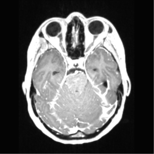 Central neurocytoma (Radiopaedia 37664-39557 Axial T1 C+ 28).png