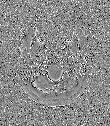 Central neurocytoma (Radiopaedia 84497-99872 Axial 5).jpg