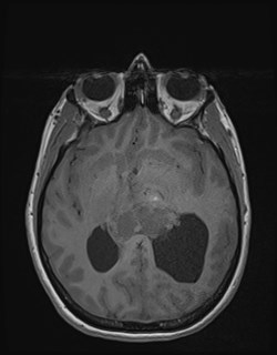 File:Central neurocytoma (Radiopaedia 84497-99872 Axial T1 102).jpg
