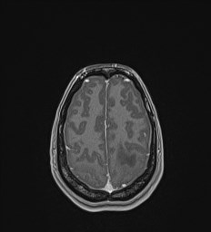 Central neurocytoma (Radiopaedia 84497-99872 Axial T1 C+ 127).jpg