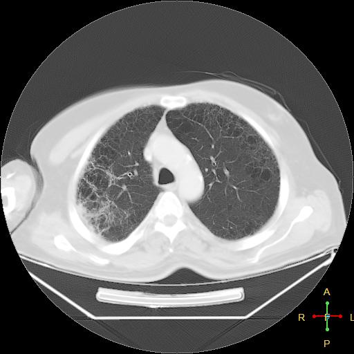 File:Centrilobular emphysema - with superimposed infection (Radiopaedia 24389-24683 lung window 9).jpg