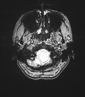 Cerebellar agenesis with hypoplastic pons (pontocerebellar hypoplasia) (Radiopaedia 57224-64138 Axial SWI 11).png