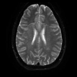 Cerebellar hemangioblastoma (Radiopaedia 29570-30077 Axial DWI 43).jpg