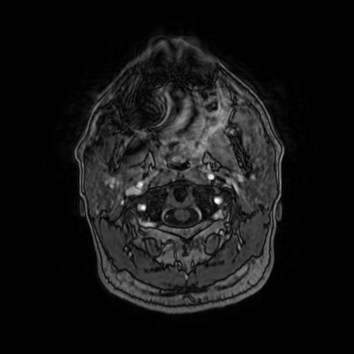 Cerebellar hemangioblastoma (Radiopaedia 88055-104622 Axial T1 C+ 15).jpg