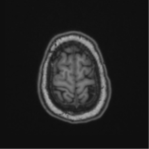 File:Cerebellar hemangioblastomas and pituitary adenoma (Radiopaedia 85490-101176 Axial T1 65).png