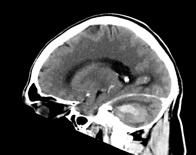 File:Cerebellar hemorrhage (Radiopaedia 37000-38671 Sagittal C+ 14).png
