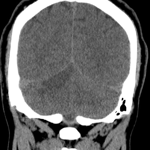 Cerebellar infarction (Radiopaedia 16625-16327 Coronal non-contrast 30).jpg