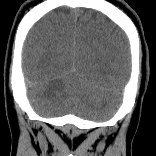 Cerebellar infarction (Radiopaedia 16625-16327 Coronal non-contrast 34).jpg