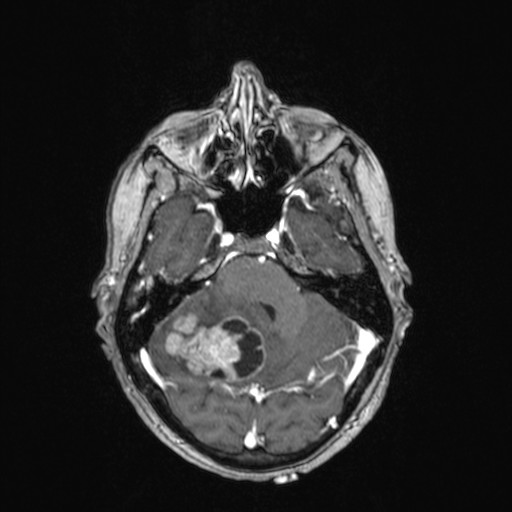 Cerebellar metastases (Radiopaedia 24038-24249 Axial T1 C+ 35).jpg