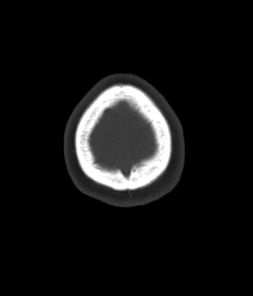 File:Cerebellar metastases - colorectal adenocarcinoma (Radiopaedia 40947-43652 AX Bone C- 2.0 MPR 63).png