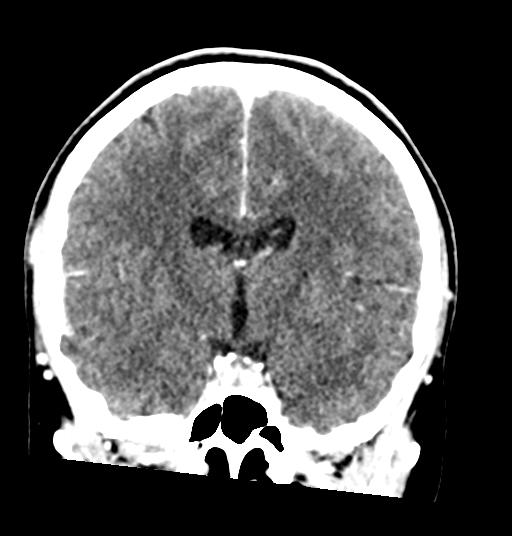 Cerebellar metastases - colorectal adenocarcinoma (Radiopaedia 40947-43652 Coronal C+ 46).png