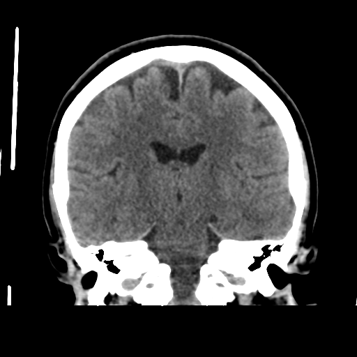 Cerebellar metastasis (cystic appearance) (Radiopaedia 41395-44258 Coronal non-contrast 35).png