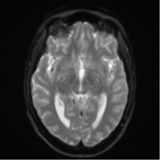 Cerebellar metastasis - adenocarcinoma lung (Radiopaedia 63184-71715 Axial DWI 14).png