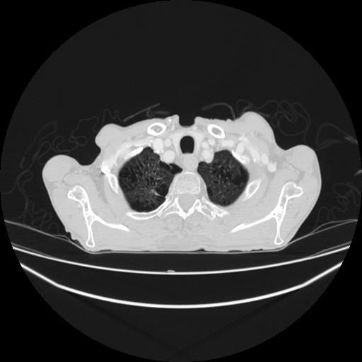 File:Cerebellar metastasis - lung tumor (Radiopaedia 69317-79150 Axial lung window 3).jpg