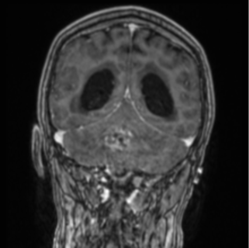 Cerebellar metastasis from lung adenocarcinoma (Radiopaedia 86690-102829 Coronal T1 C+ 34).png