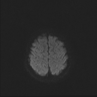 File:Cerebellar stroke (Radiopaedia 32202-33150 Axial DWI 42).png