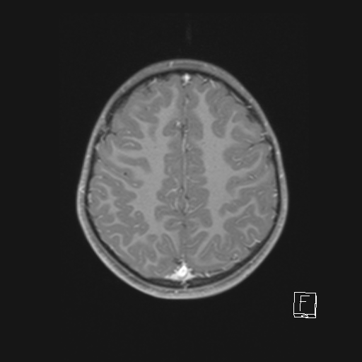 Cerebellar stroke (Radiopaedia 32202-33150 Axial T1 C+ 53).png