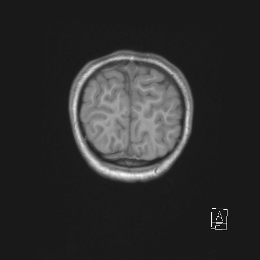 Cerebellar stroke (Radiopaedia 32202-33150 Coronal T1 57).png