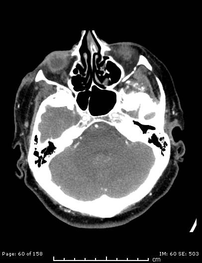 Cerebellar strokes due to intracranial giant cell arteritis (Radiopaedia 68799-78510 CT angiogram 60).jpg